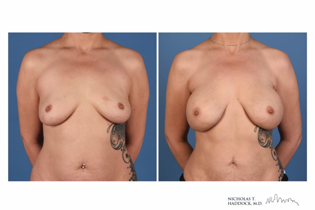 Robotic nipple-sparing mastectomy before and after, front view &mdash; before on the left, after on the right (case 2 of 2)