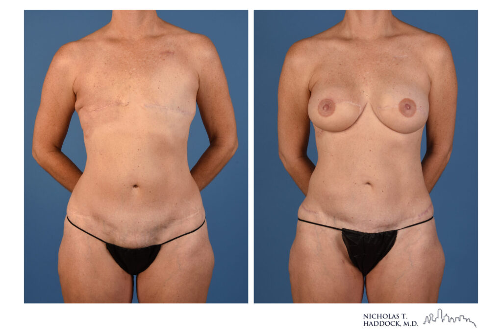 LAP flap breast reconstruction, front view &mdash; before on the left, after on the right
