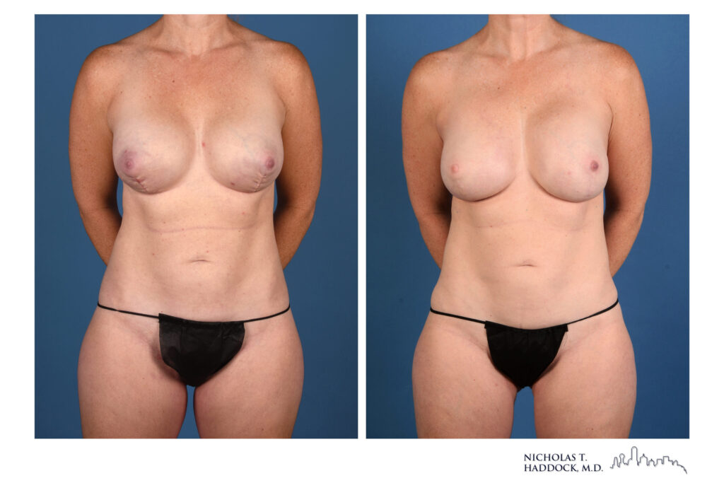 LAP flap breast reconstruction, front view &mdash; before on the left, after on the right