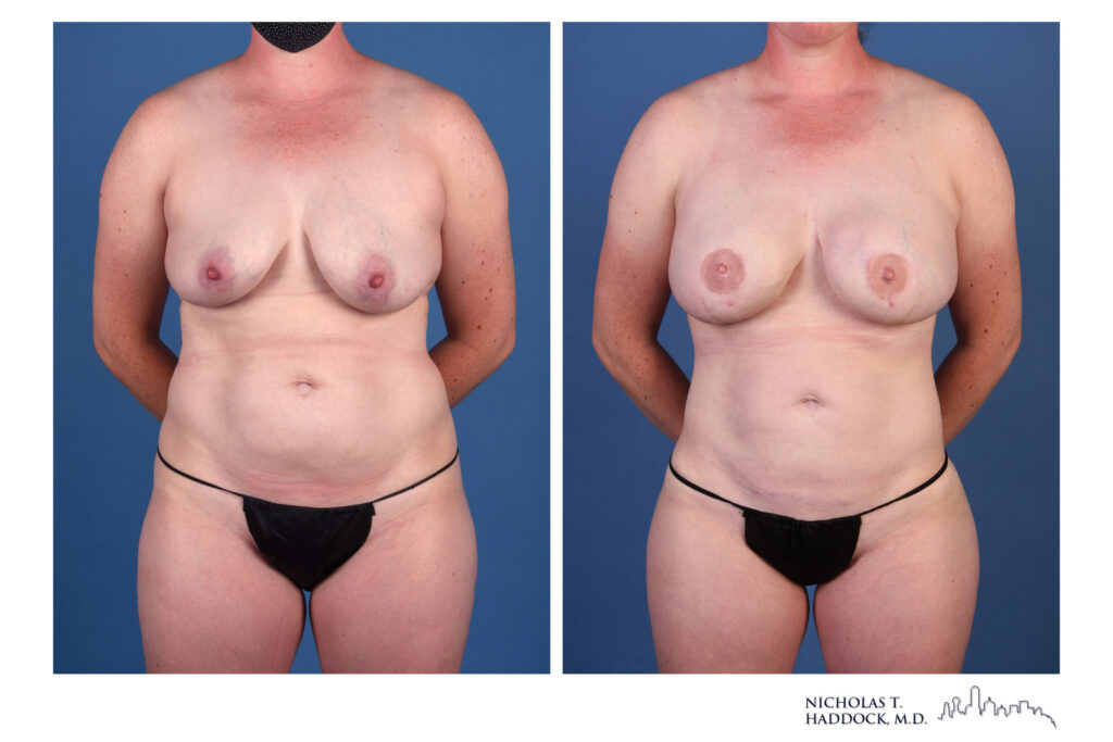 LAP flap breast reconstruction, front view &mdash; before on the left, after on the right