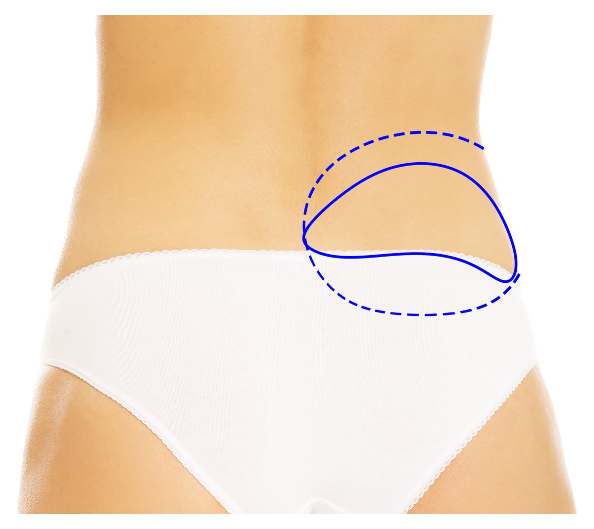 Illustration of a lower back showing the LAP flap incision outline, sitting low enough to be covered by underwear