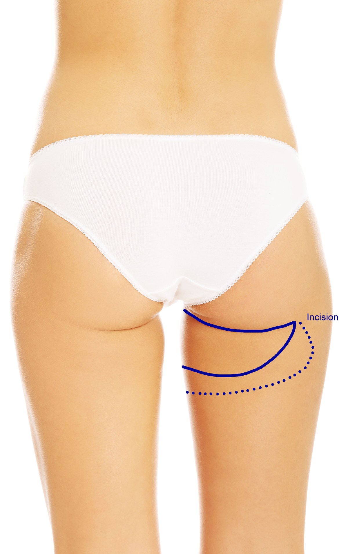 Illustration of the horizontal PAP flap incision on the back of the thigh, positioned in the crease beneath the buttock