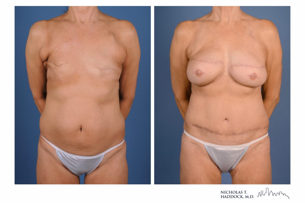 Stacked flap breast reconstruction, front view &mdash; before on the left, after on the right