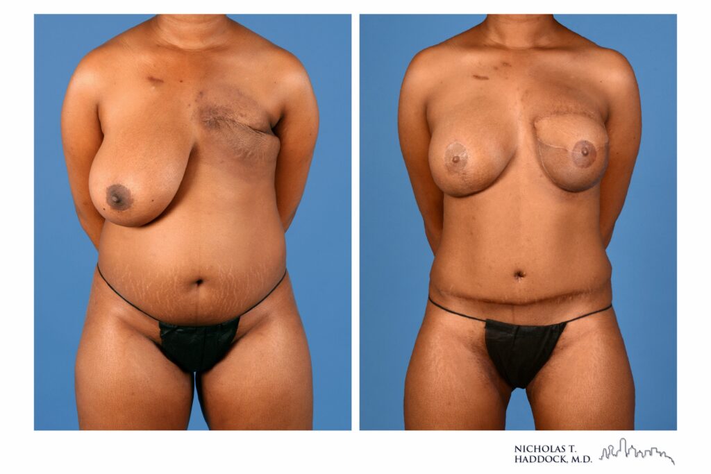 Stacked flap breast reconstruction, front view &mdash; before on the left, after on the right