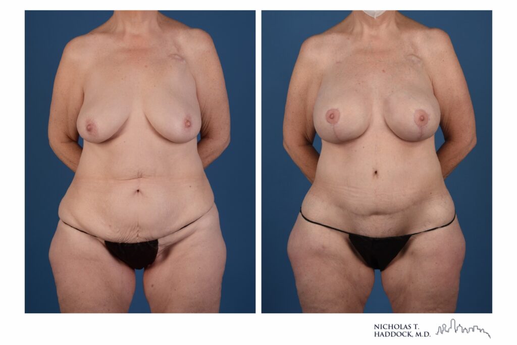 Stacked flap breast reconstruction, front view &mdash; before on the left, after on the right