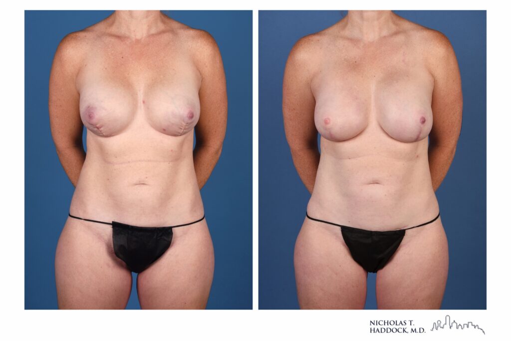 Stacked flap breast reconstruction, front view &mdash; before on the left, after on the right