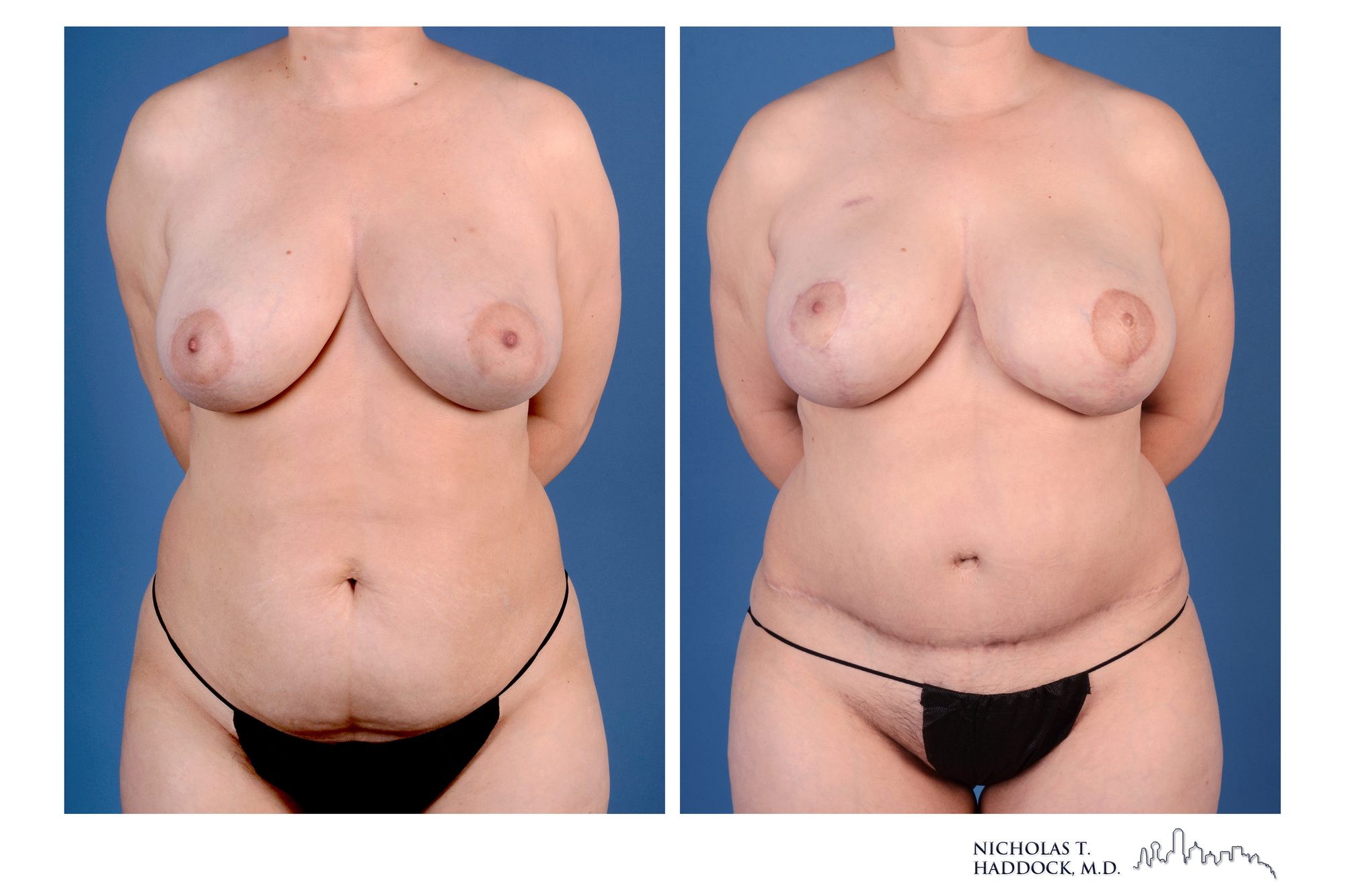 Left breast reconstruction with a DIEP flap and right breast lift, before and after, front view, 1 year 5 months after surgery