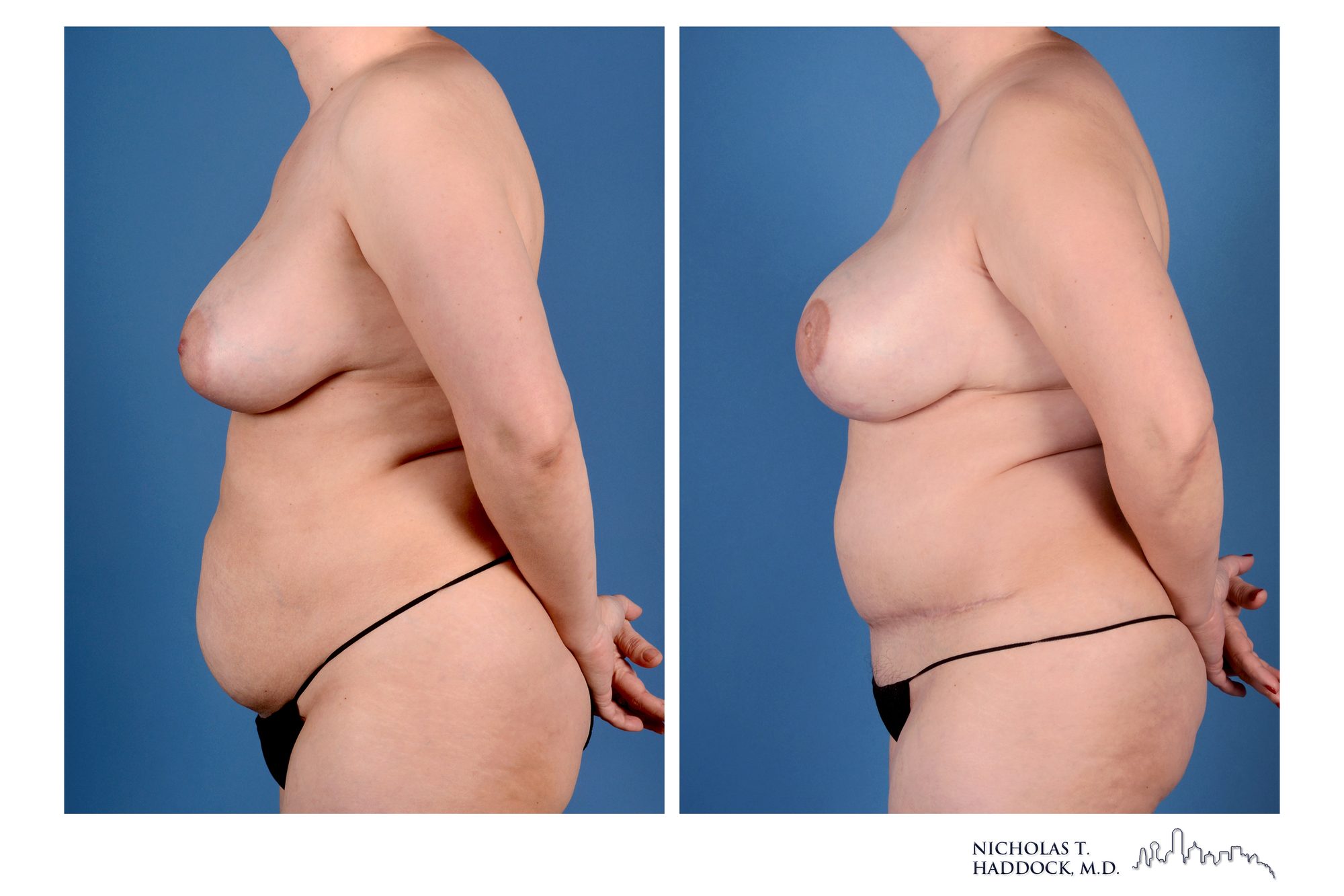 DIEP flap breast reconstruction, before and after, left side view, 1 year 5 months after surgery