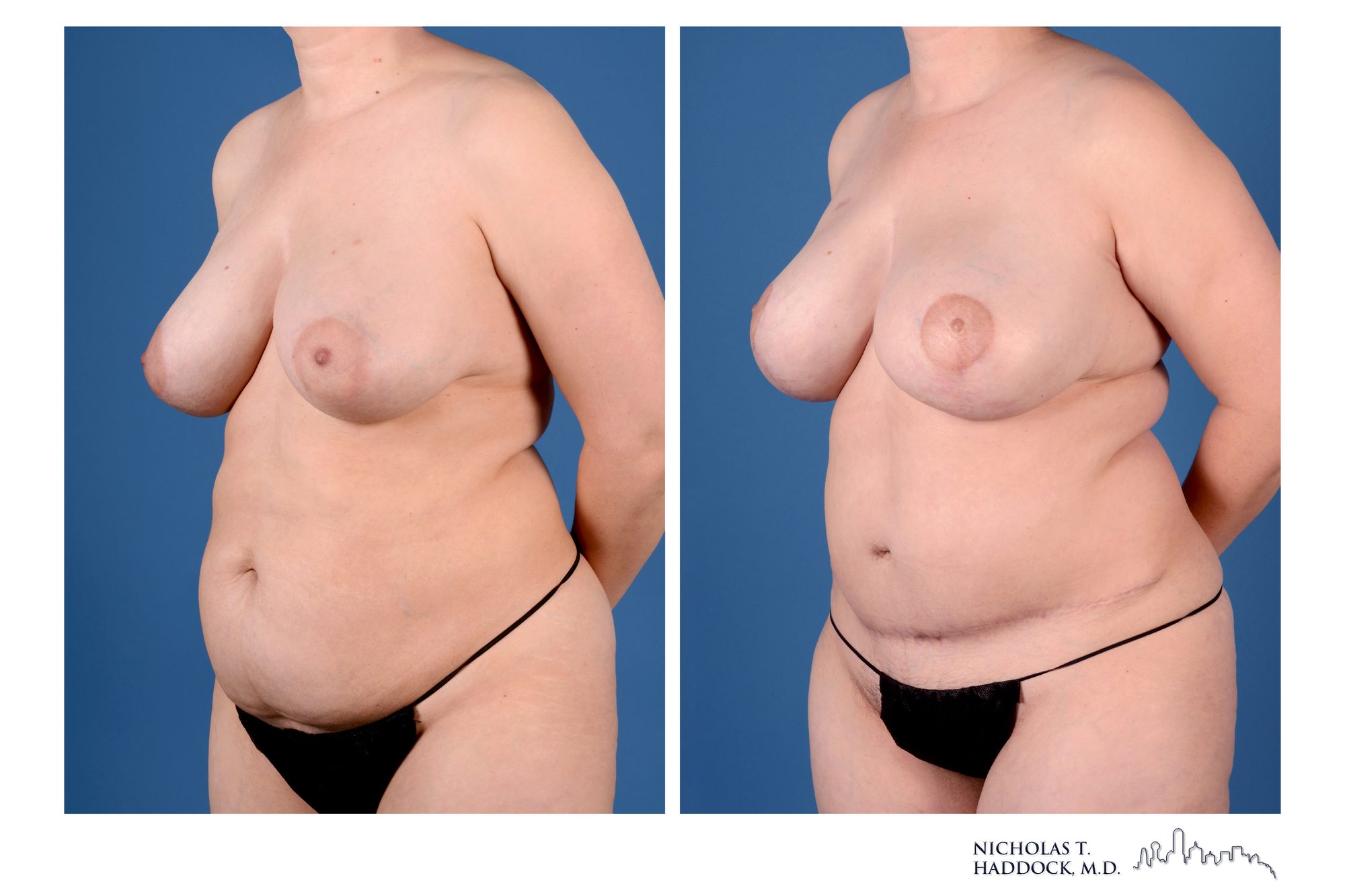 DIEP flap breast reconstruction, before and after, left oblique view, 1 year 5 months after surgery