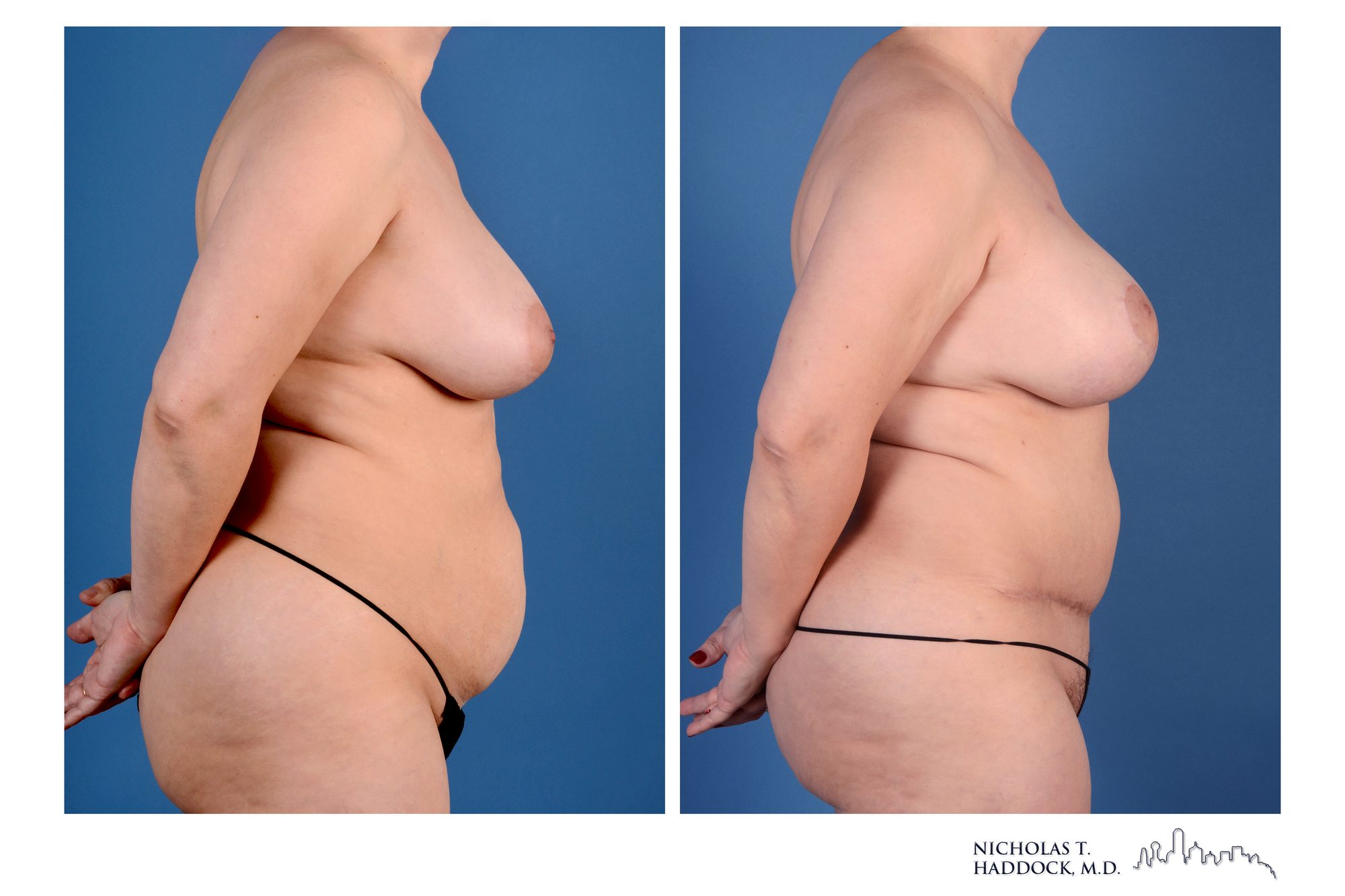 DIEP flap breast reconstruction, before and after, right side view, 1 year 5 months after surgery