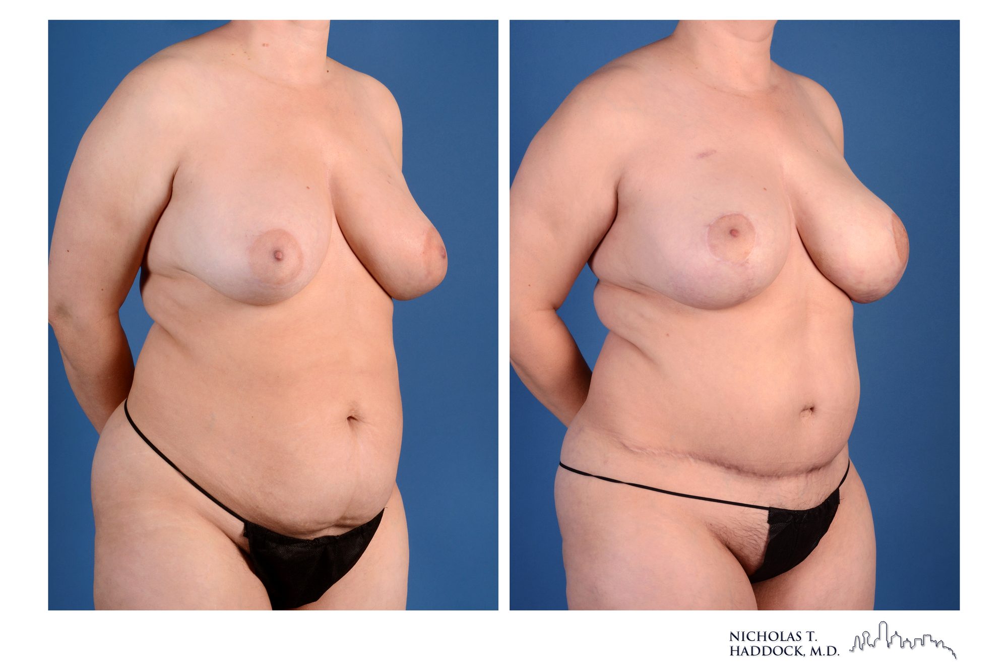 DIEP flap breast reconstruction, before and after, right oblique view, 1 year 5 months after surgery
