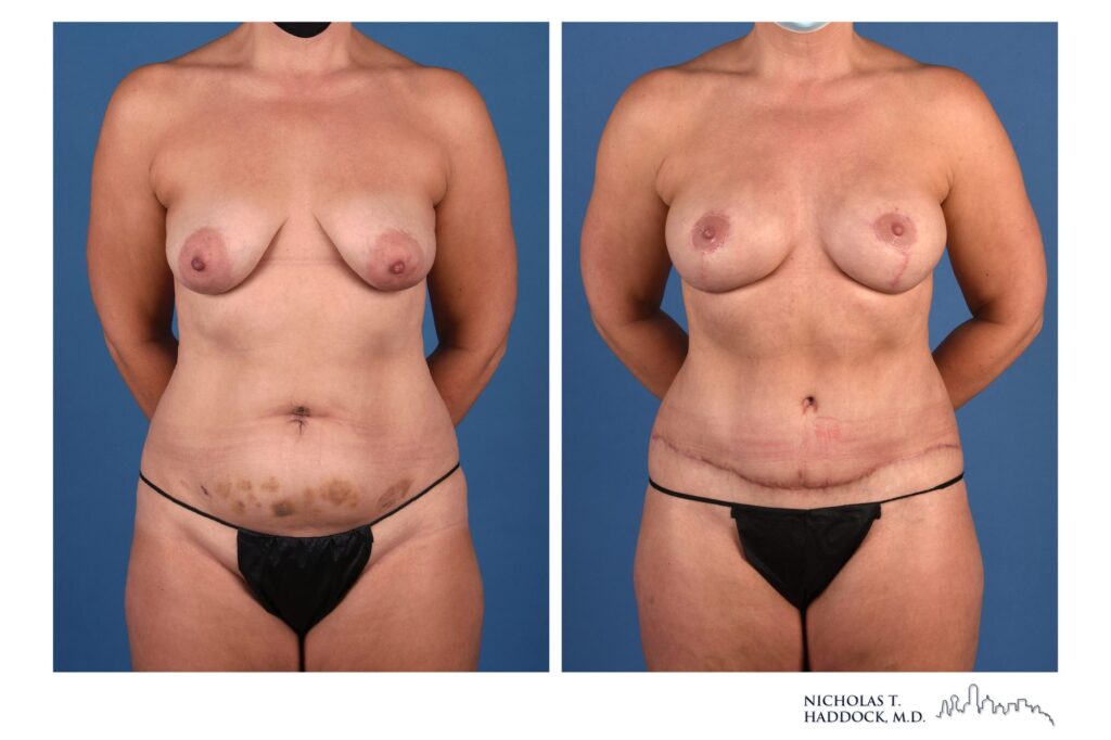 DIEP flap breast reconstruction, before and after, front view, 9 months after surgery