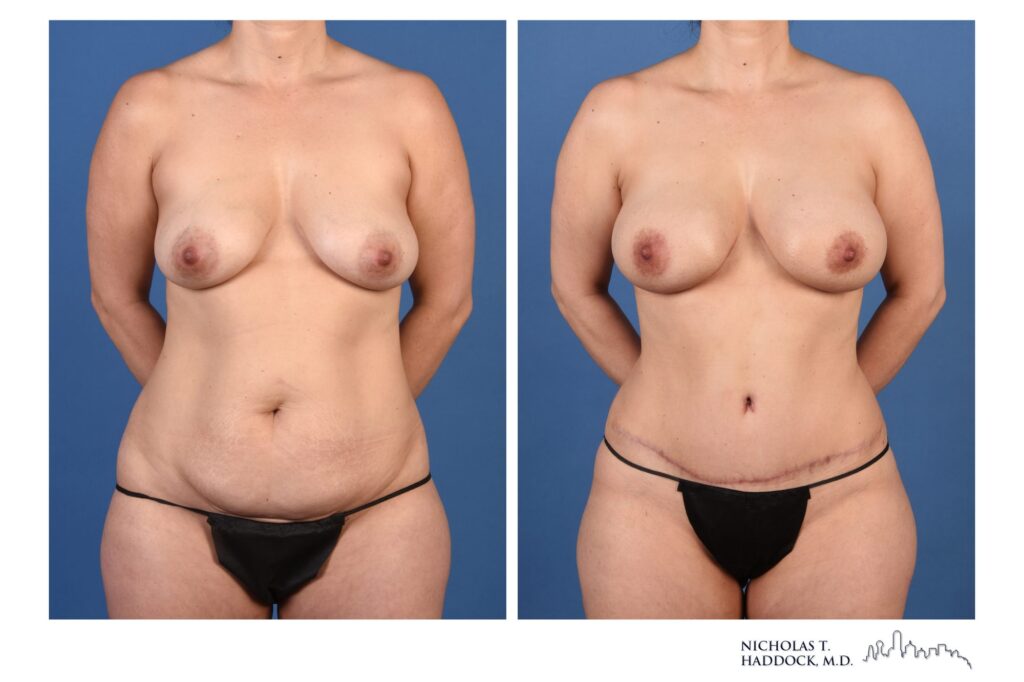 DIEP flap breast reconstruction, before and after, front view, 6 months after surgery