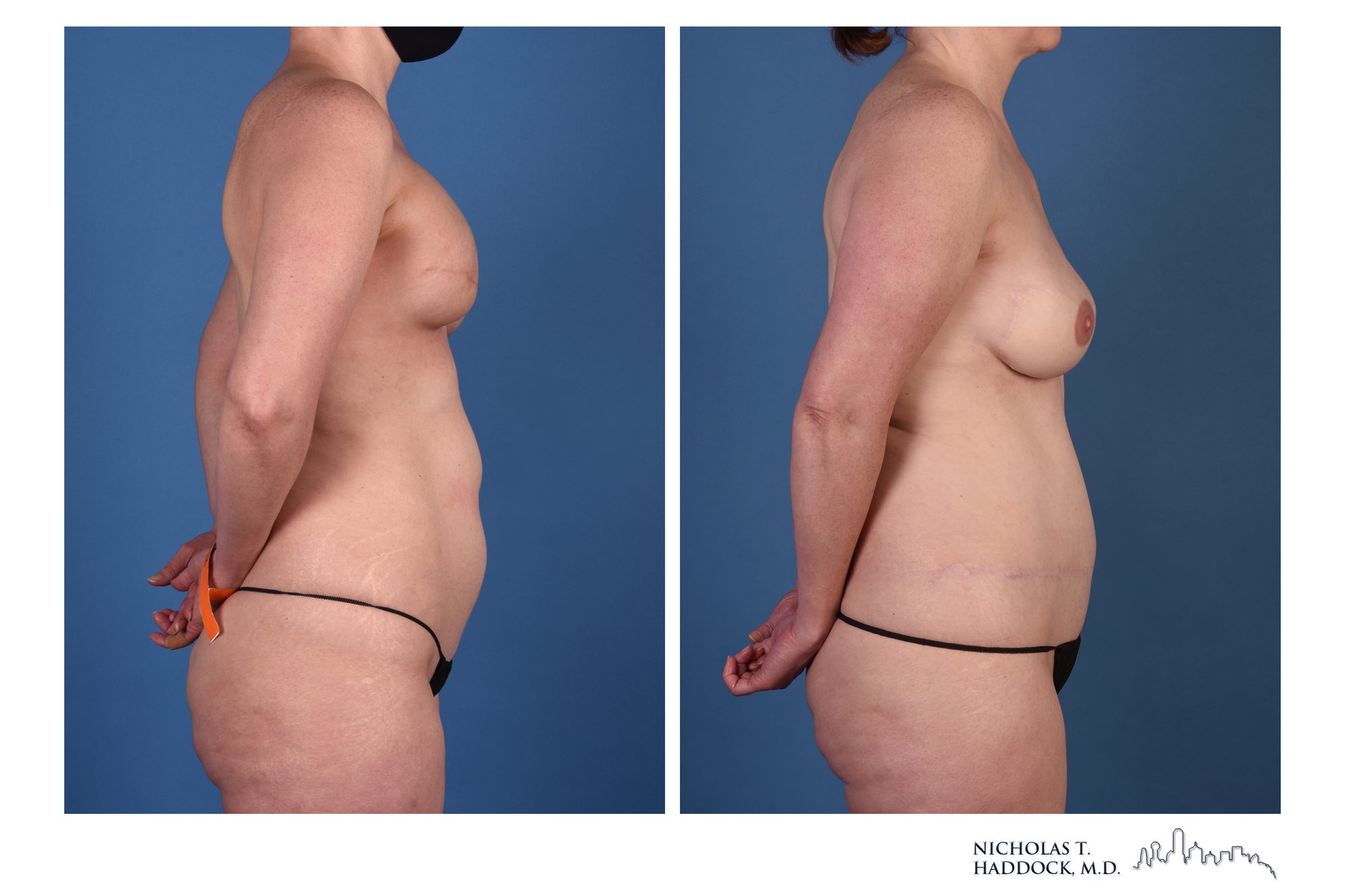 DIEP flap breast reconstruction, before and after, right side view, 1 year 6 months after surgery