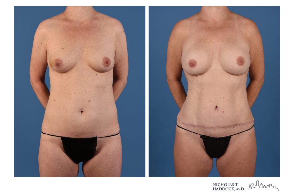 DIEP flap breast reconstruction, before and after, front view, 2 years 5 months after surgery