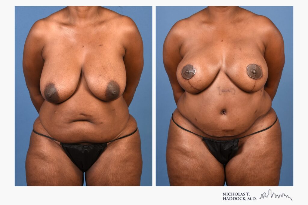 DIEP flap breast reconstruction, before and after, front view, 10 months after surgery