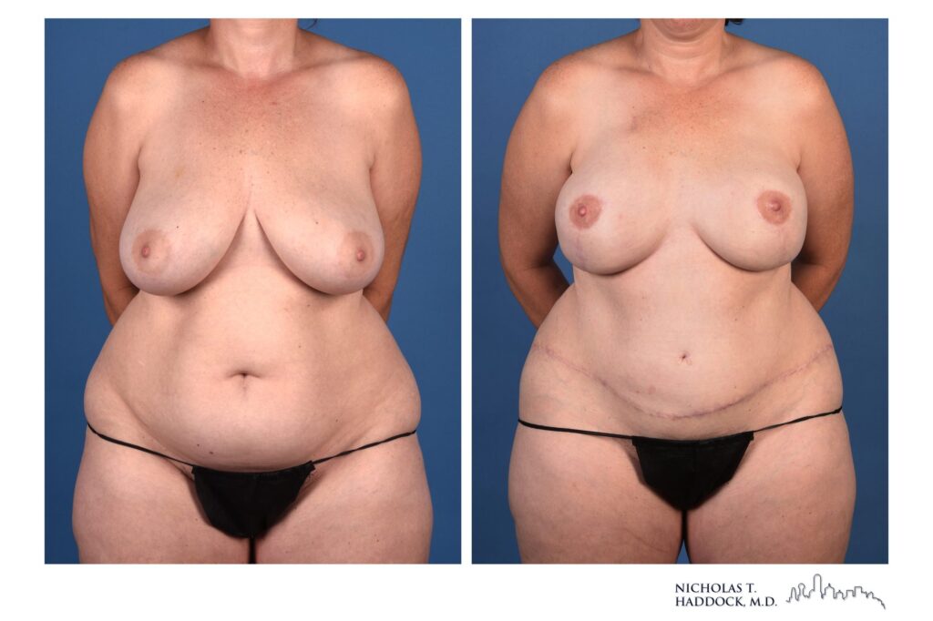 DIEP flap breast reconstruction, before and after, front view, 1 year 3 months after surgery