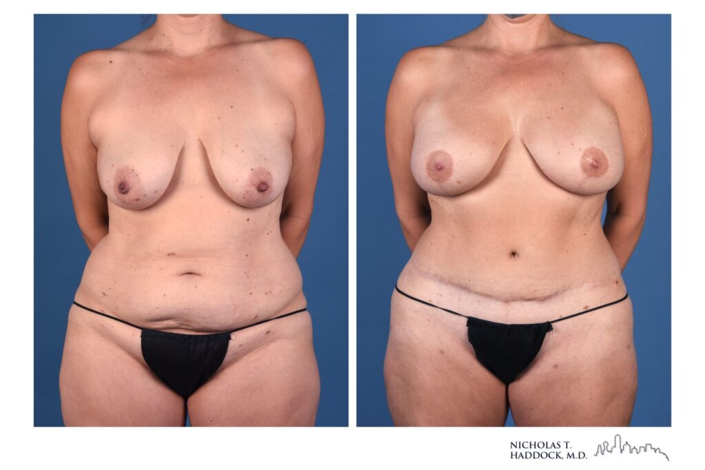 DIEP flap breast reconstruction, before and after, front view, 2 years after surgery