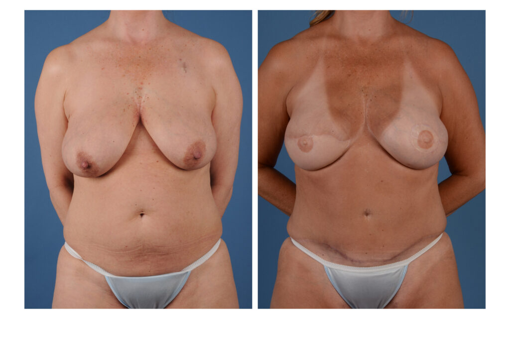 Stacked flap breast reconstruction, front view &mdash; before on the left, after on the right