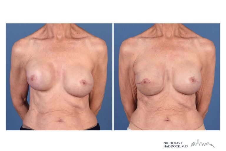 Implant revision before and after, front view — before on the left, after on the right