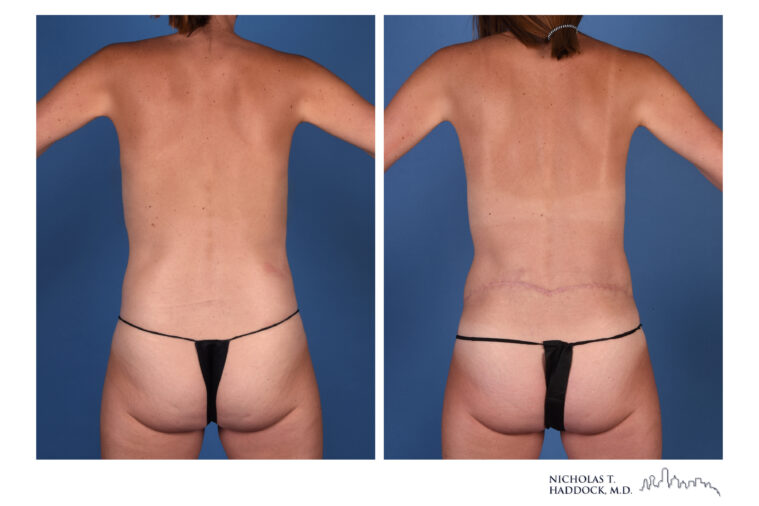 LAP flap Before and After Photo LAP flap Before and After Photo