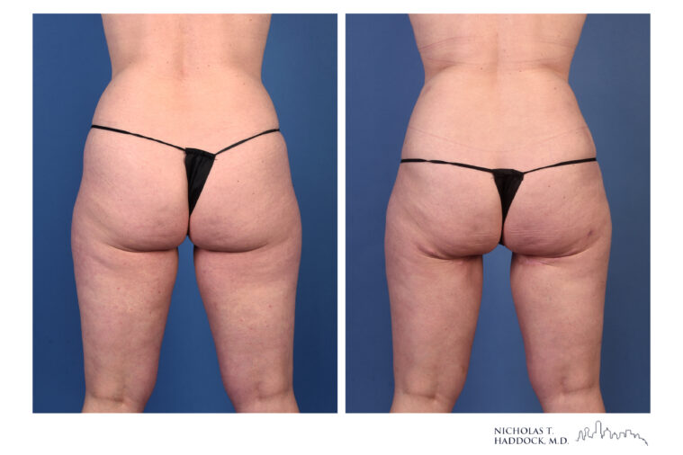 rNSM PAP Flap Breast Reconstruction