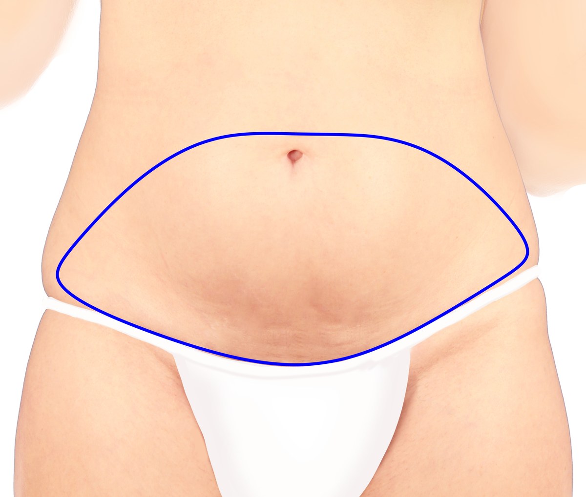 Illustration of the lower abdomen with the DIEP flap outlined: skin and fat from hip to hip, between just above the belly button and the bikini line