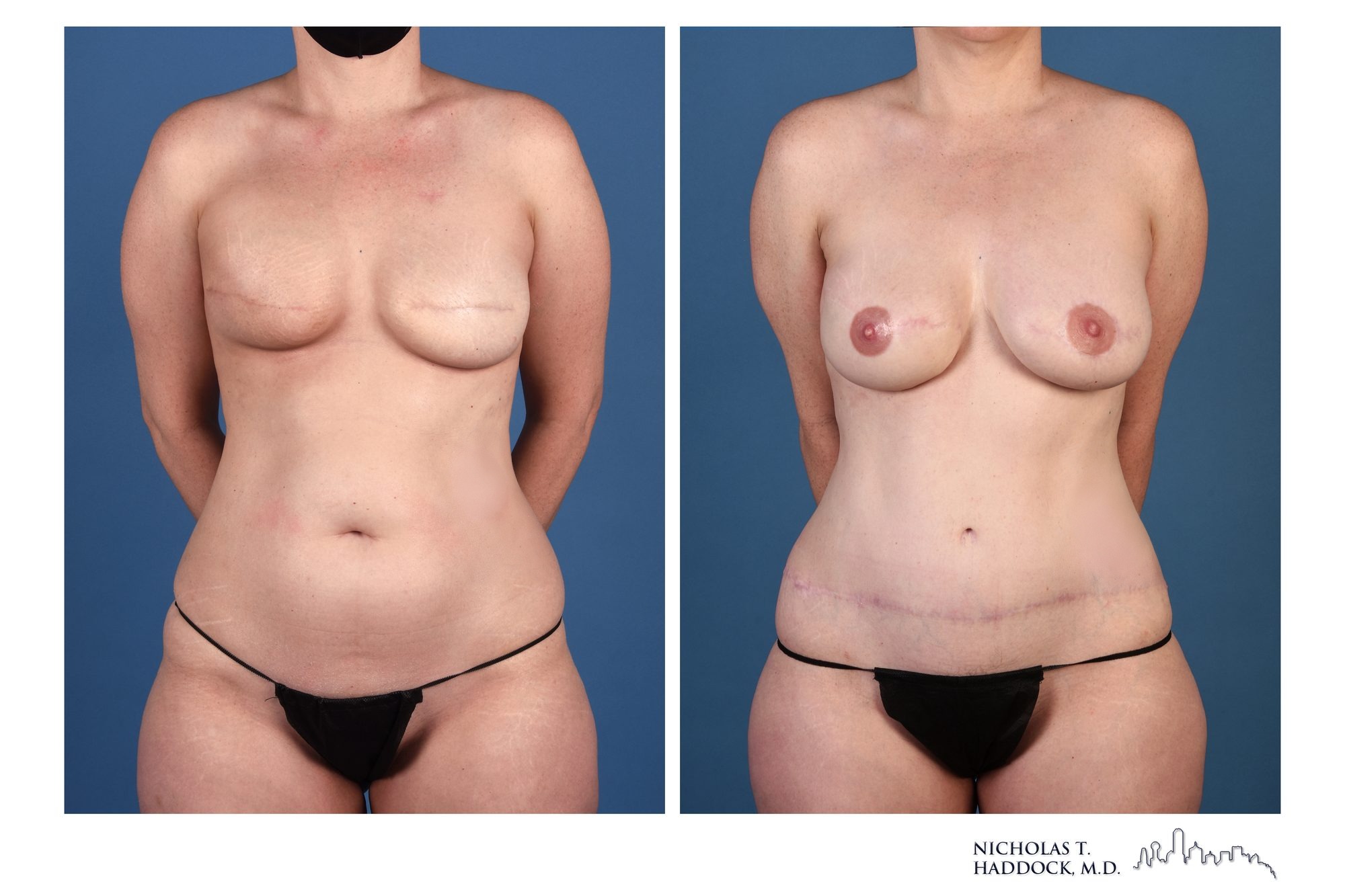 DIEP flap breast reconstruction after conversion from implants, before and after, front view, 1 year 6 months after surgery