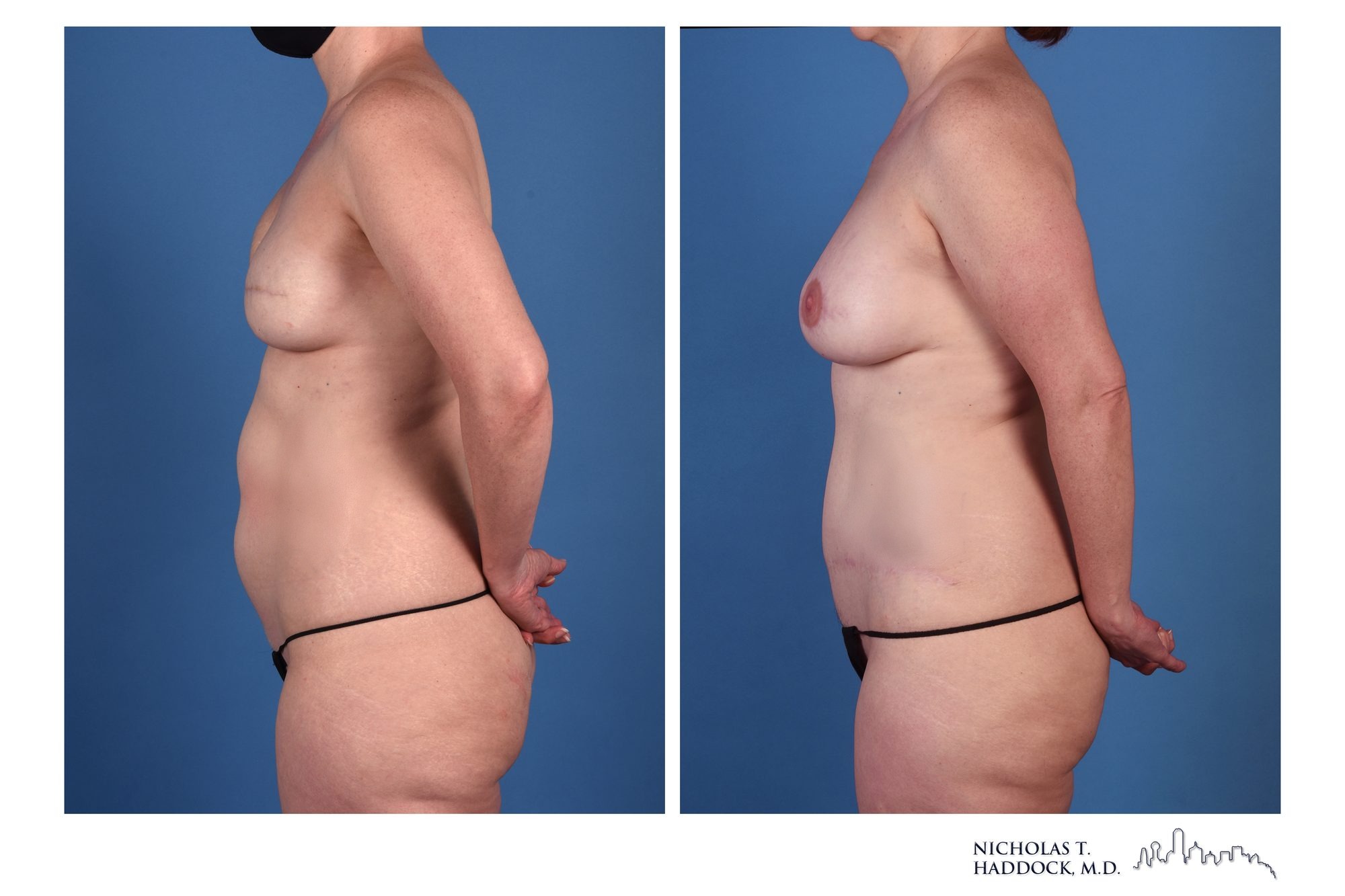 DIEP flap breast reconstruction, before and after, left side view, 1 year 6 months after surgery