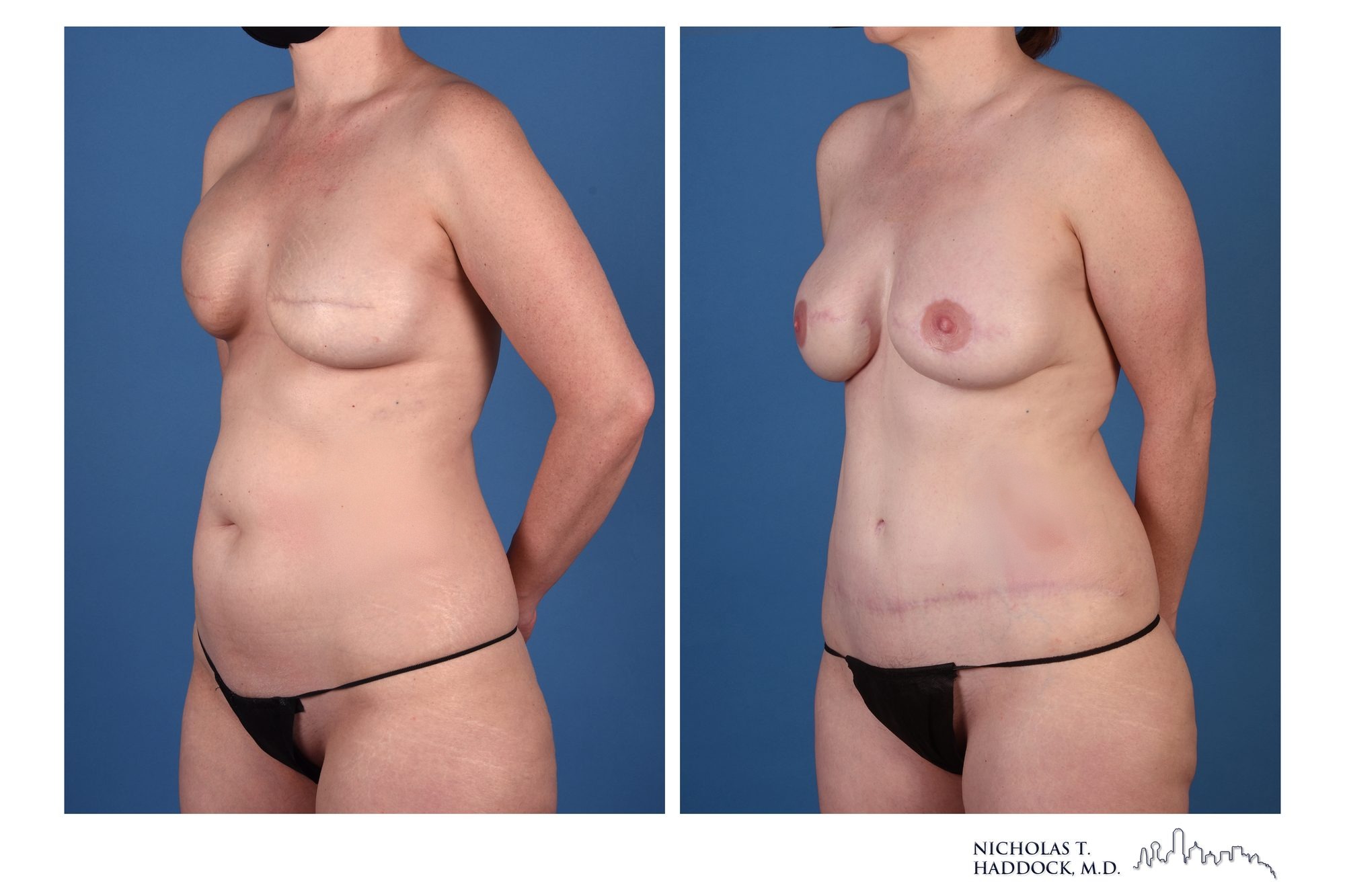 DIEP flap breast reconstruction, before and after, left oblique view, 1 year 6 months after surgery