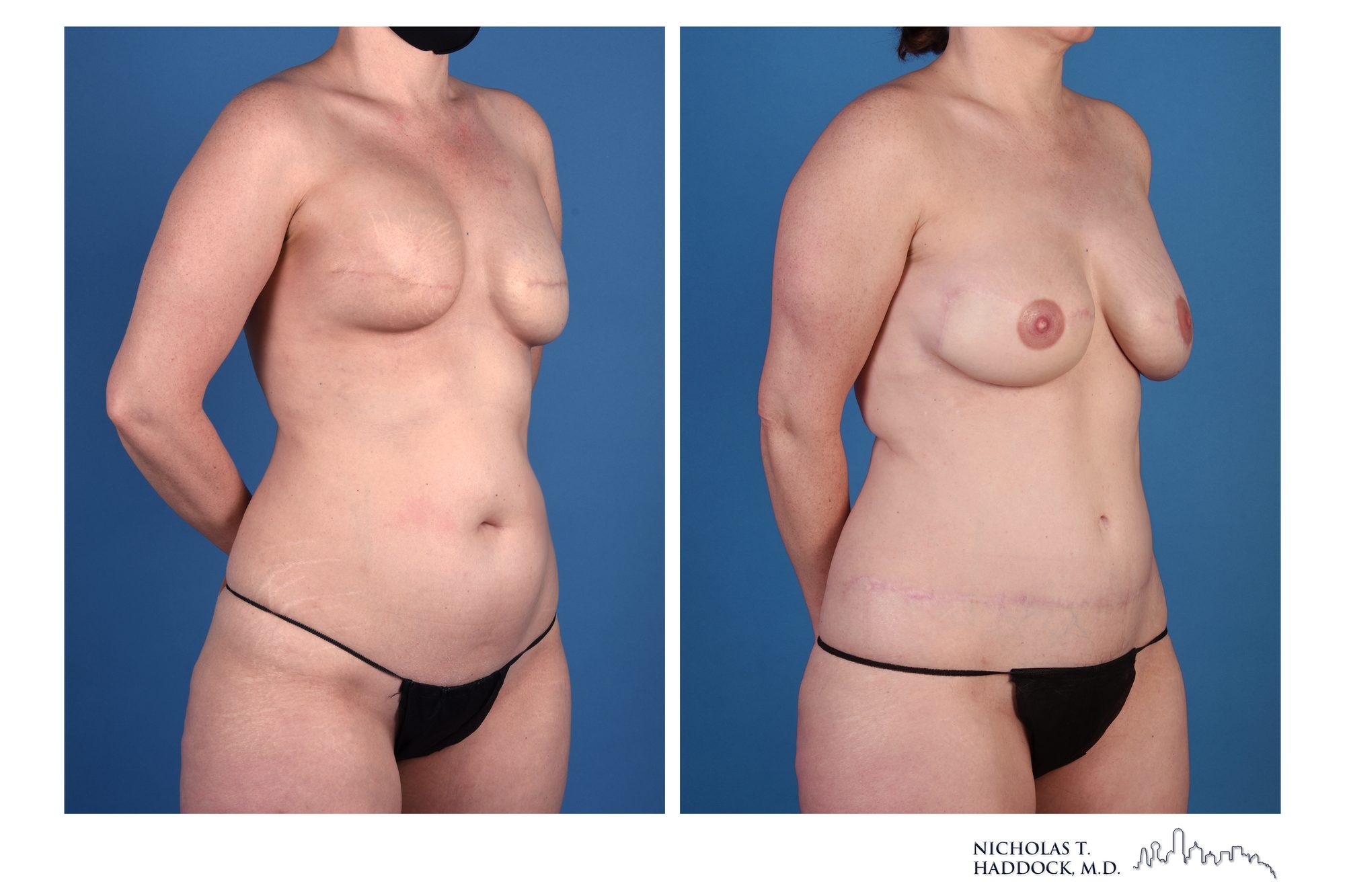 DIEP flap breast reconstruction, before and after, right oblique view, 1 year 6 months after surgery